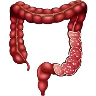 Colon avec RCH sévère